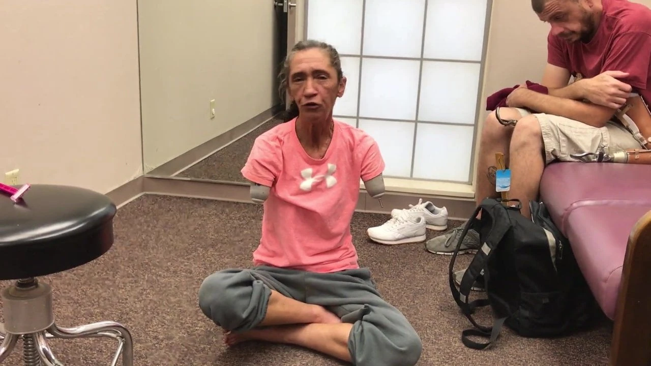 mature double arm amputee