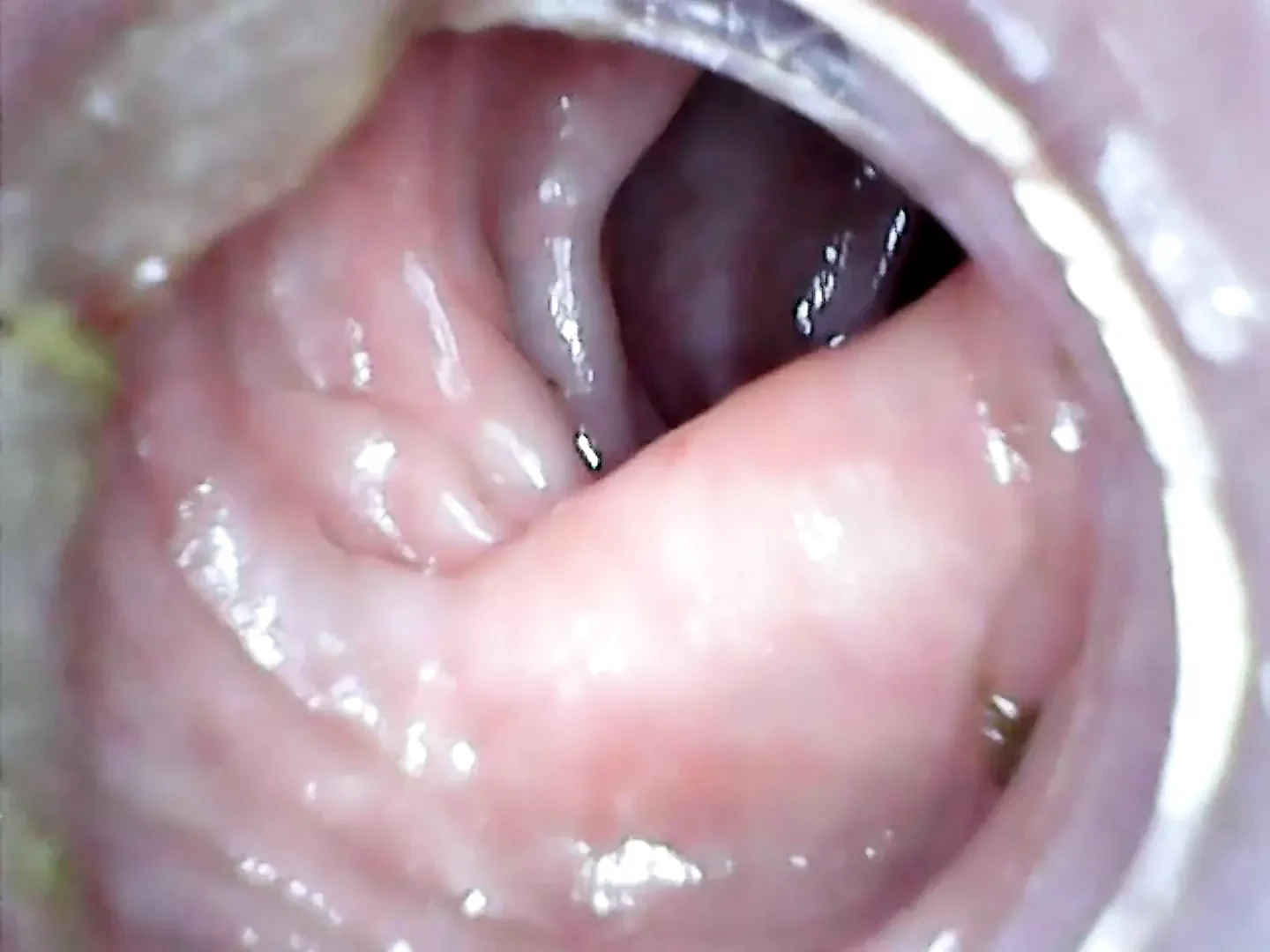 Anal endoscope part 2